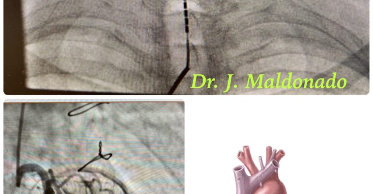 Implante de Estimulador Medular en pacientes con angina refractaria