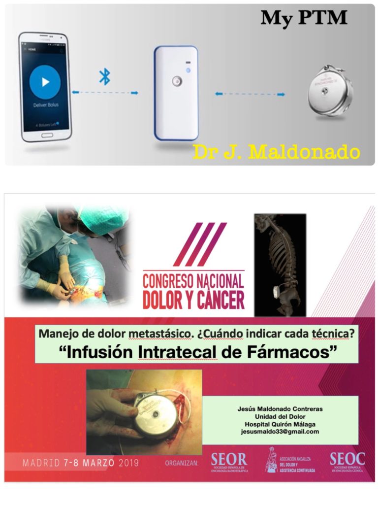 My PTM: Sistema de liberación de bolos intratecales para controlar el dolor irruptivo en pacientes con dolor oncológico metastásico.